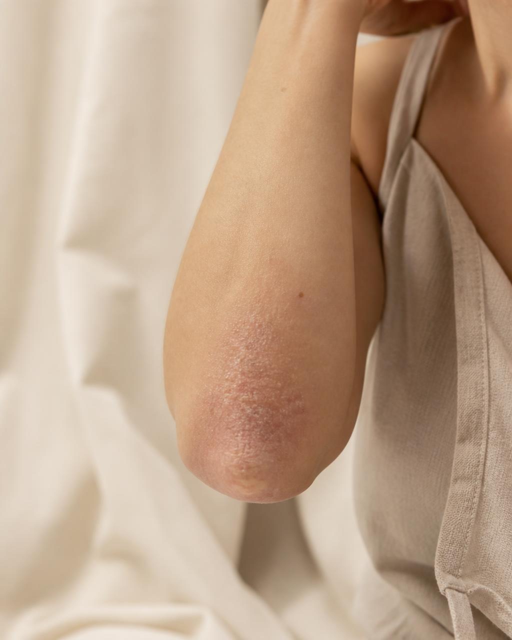 Psoriasis control